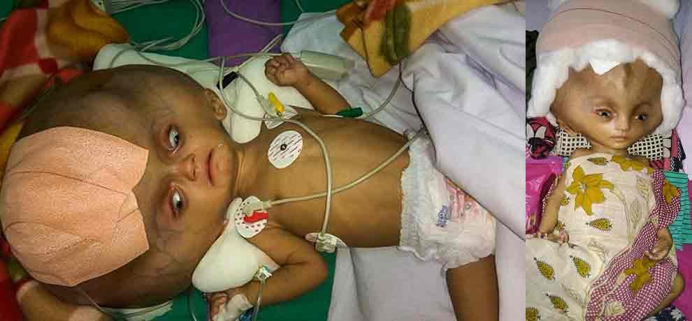 7 month old baby called ghost because he was having worlds largest head after disease 