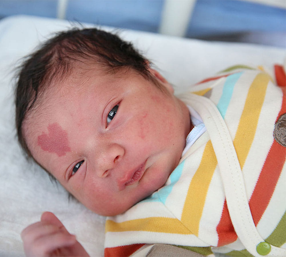 baby born with heart shape birth mark