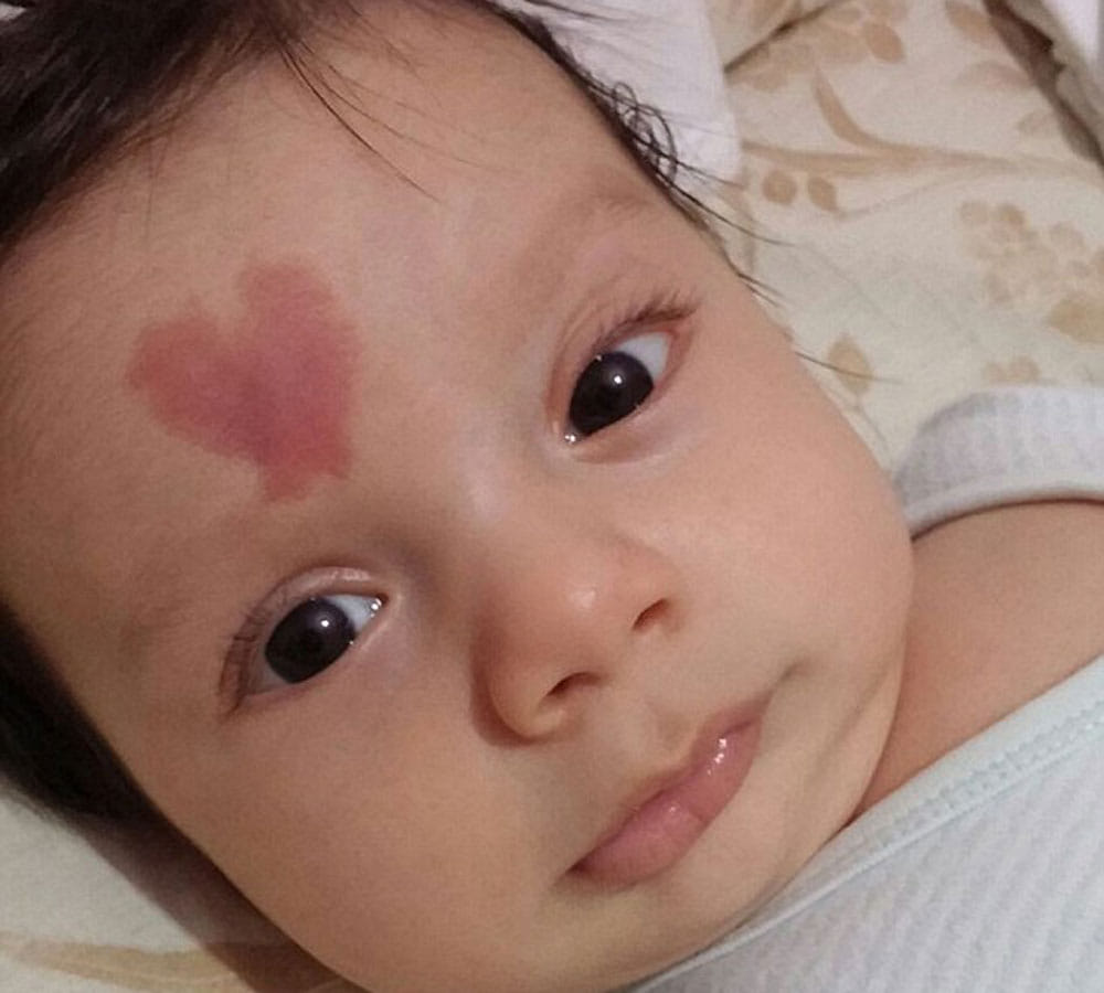 baby born with heart shape birth mark