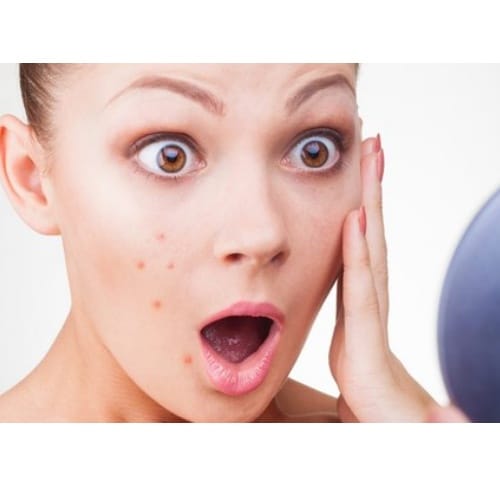 can aspirin be used for acne, what expert says