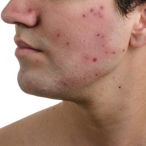 can aspirin be used for acne, what expert says