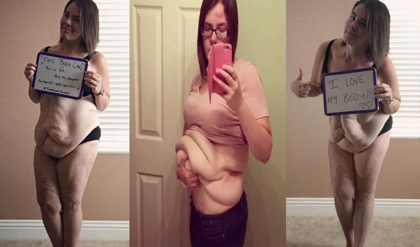 Women In California Has 9 Kg Of Loose Skin