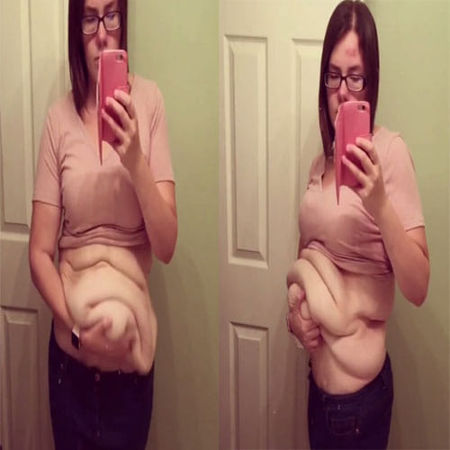 Women In California Has 9 Kg Of Loose Skin
