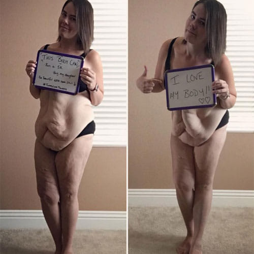 Women In California Has 9 Kg Of Loose Skin
