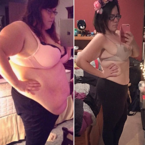 Women In California Has 9 Kg Of Loose Skin