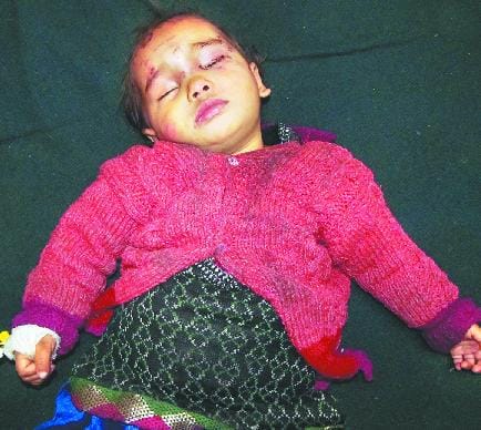 two children in chalara scratched by monkey