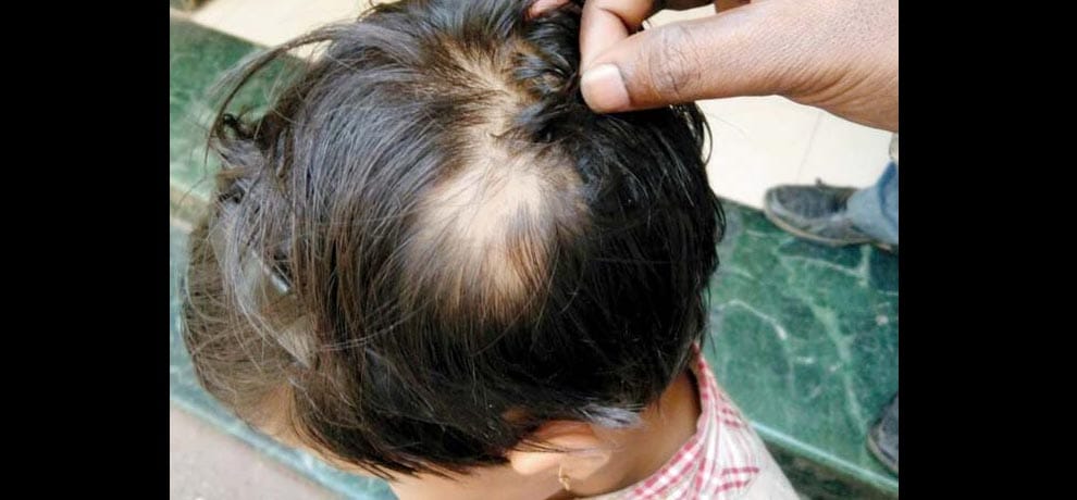  teacher uproots hair of girl over late fees in pune