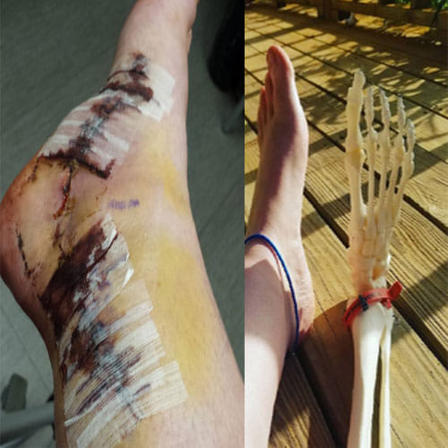 Girl In America Kept Her Leg After Doctor Cut It Off From Her Body