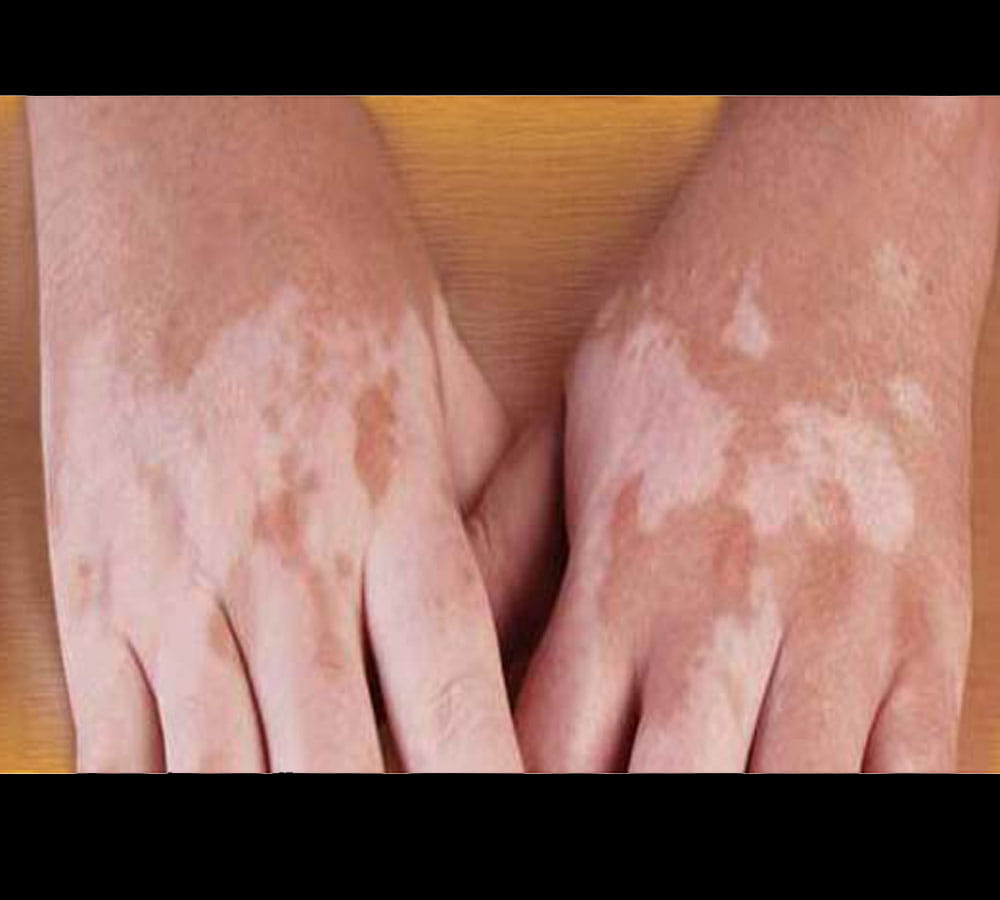 get rid of leucoderma at home easily
