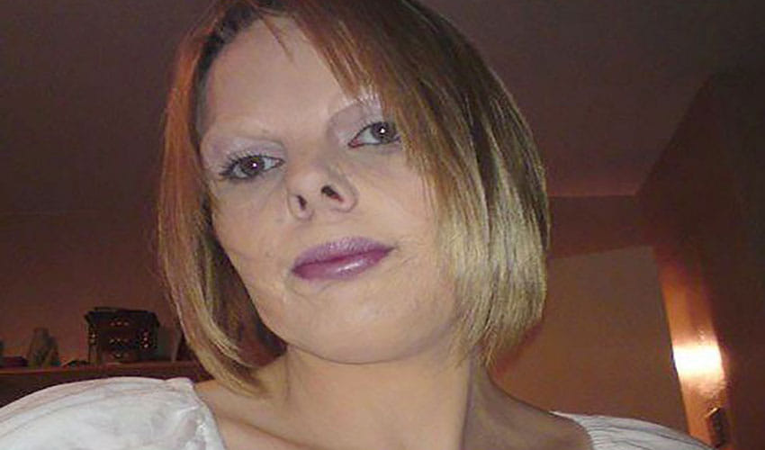 wrong surgery spoil the face