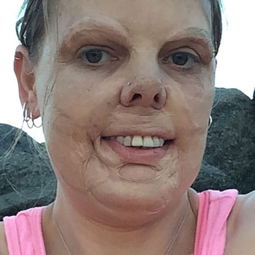 wrong surgery spoil the face