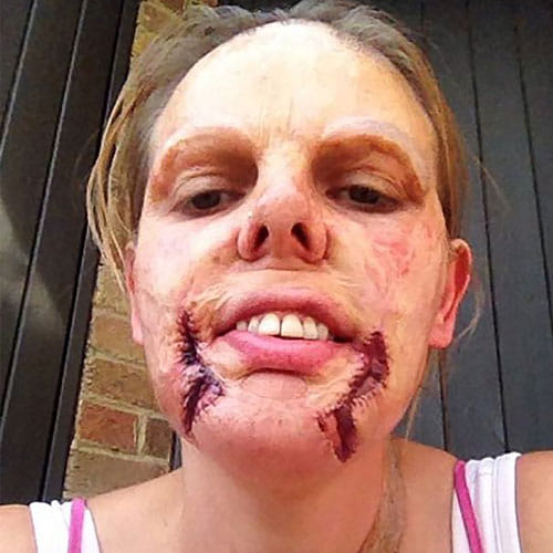 wrong surgery spoil the face