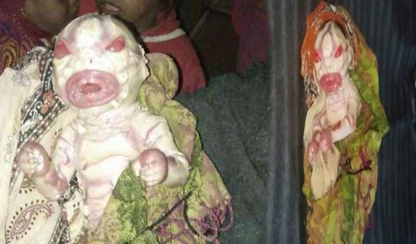Baby Girl Born In Patna Looks Like Alien
