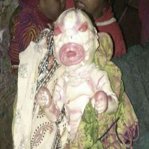 Baby Girl Born In Patna Looks Like Alien