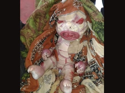 Baby Girl Born In Patna Looks Like Alien
