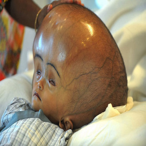Baby Girl Born In Patna Looks Like Alien