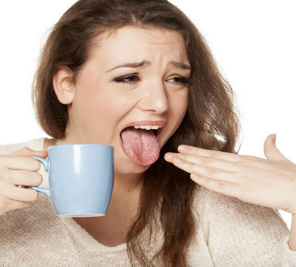 how to heel burnt tongue and palate 