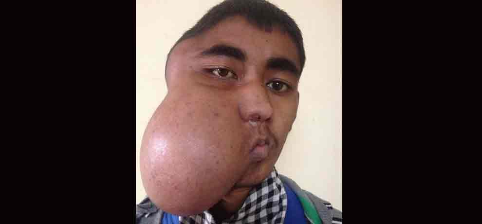 six people in the world are suffering from this disease, 17 year old boy from india is sixth patient