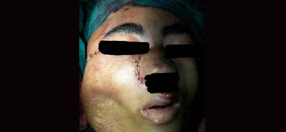 six people in the world are suffering from this disease, 17 year old boy from india is sixth patient