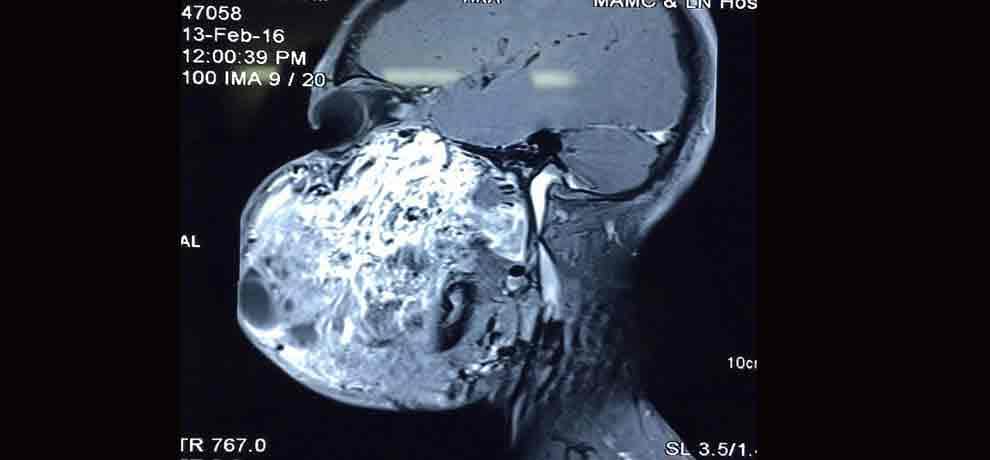 six people in the world are suffering from this disease, 17 year old boy from india is sixth patient