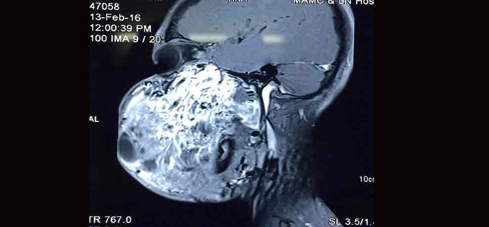 six people in the world are suffering from this disease, 17 year old boy from india is sixth patient