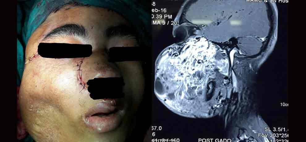 six people in the world are suffering from this disease, 17 year old boy from india is sixth patient