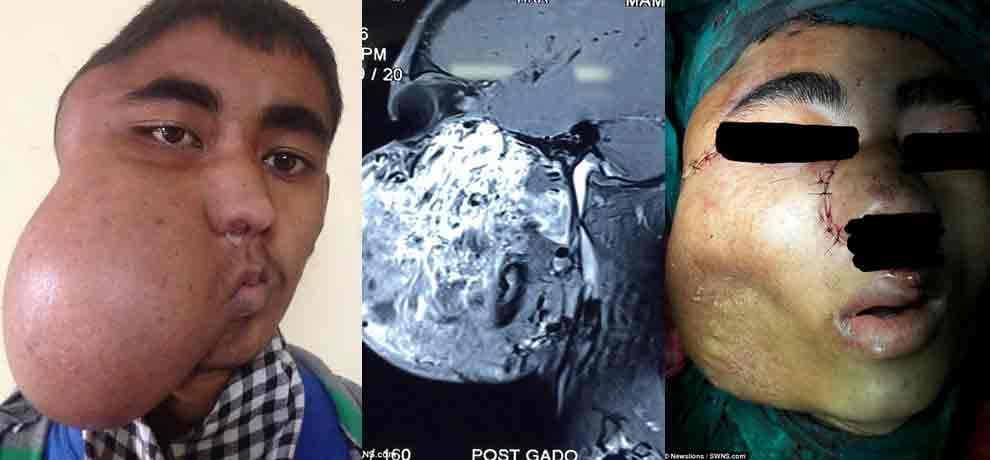 six people in the world are suffering from this disease, 17 year old boy from india is sixth patient