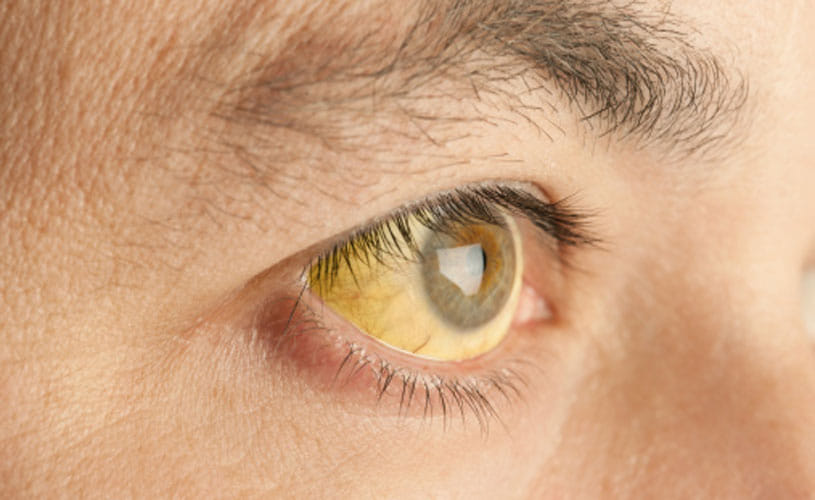Jaundice Pills Are Harmful For Your Kidney