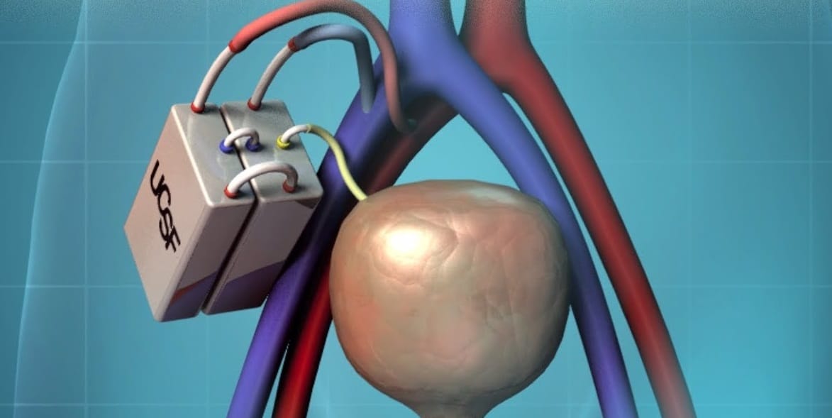 Artificial kidney may hit market by end of decade