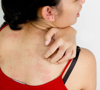 Fungal and allergy patients increased in summer