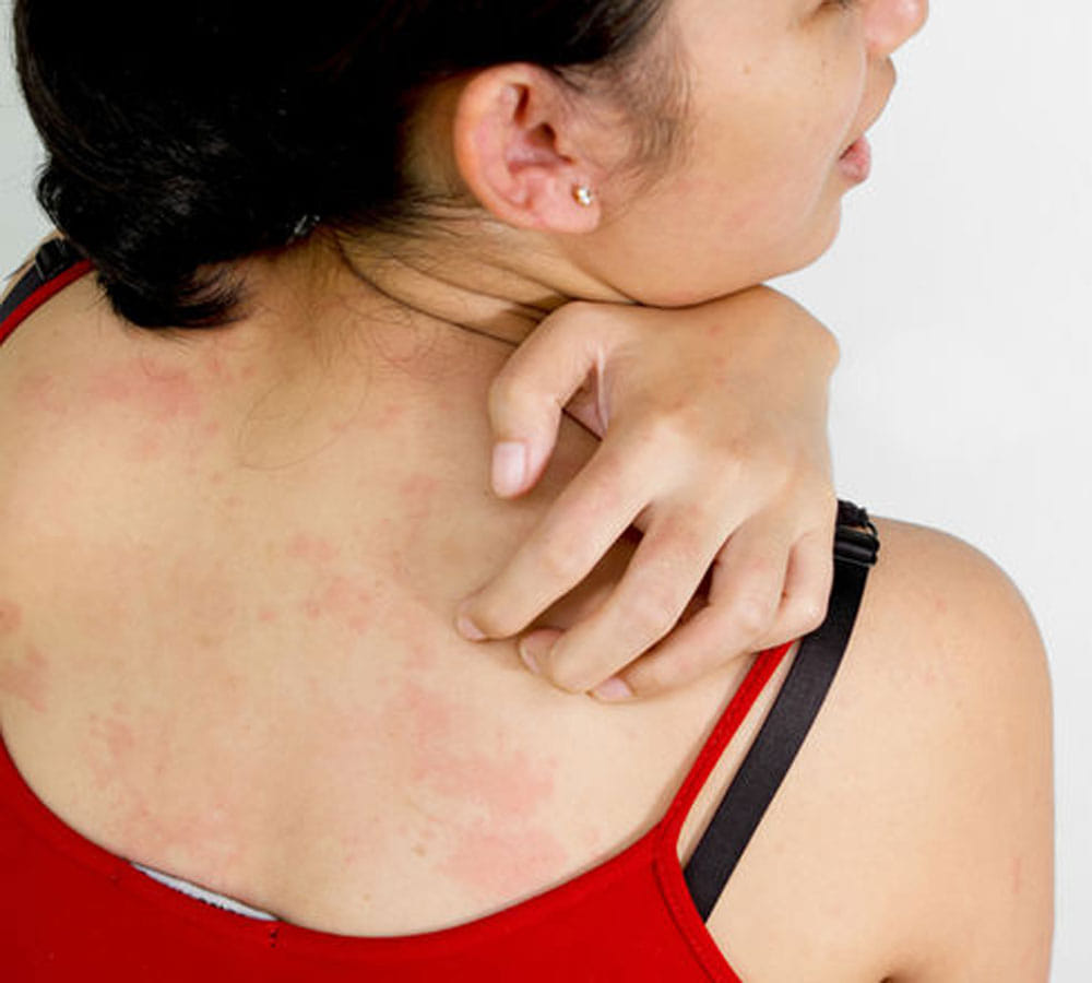 rashes in winters because of woolen clothes