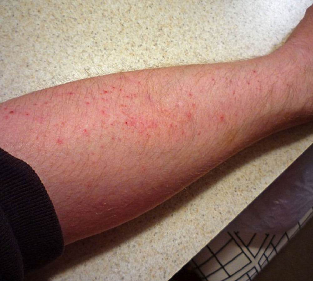 rashes in winters because of woolen clothes