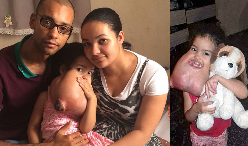 Girl In Brazil Had 2 Kg Tumour Now Has Been Revoverd