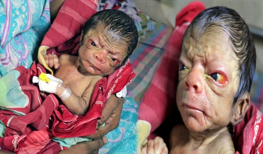 Newborn Baby In Bangladesh Looks Like An 80 Year Old Man