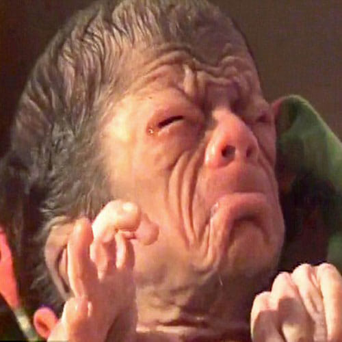 Newborn Baby In Bangladesh Looks Like An 80 Year Old Man