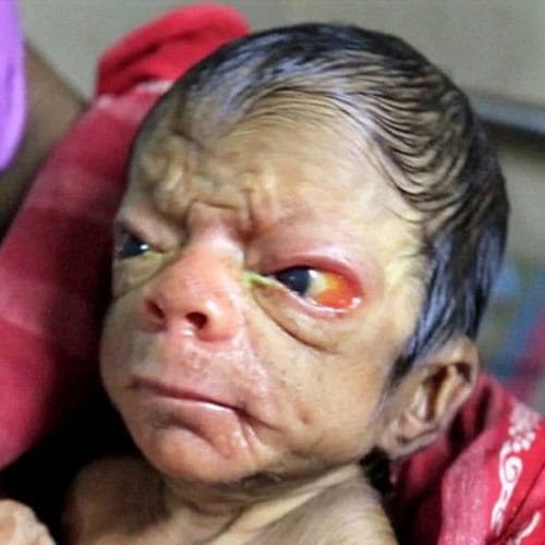Newborn Baby In Bangladesh Looks Like An 80 Year Old Man