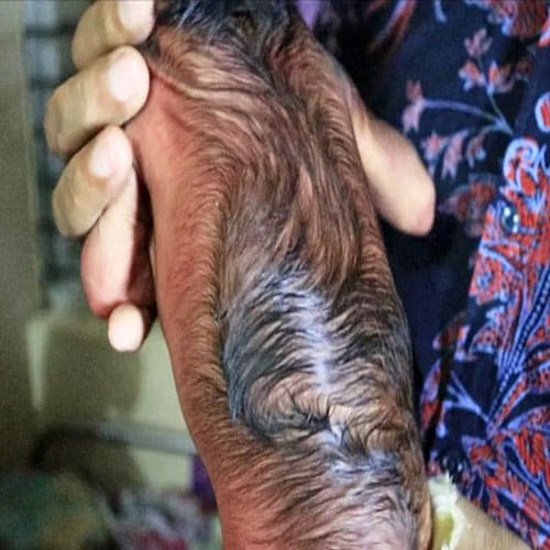 Newborn Baby In Bangladesh Looks Like An 80 Year Old Man