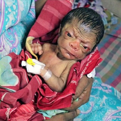 Newborn Baby In Bangladesh Looks Like An 80 Year Old Man