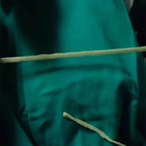 2 Meter Long Tapeworm Pulled Out Of A Man's Stomach