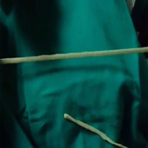 2 Meter Long Tapeworm Pulled Out Of A Man's Stomach