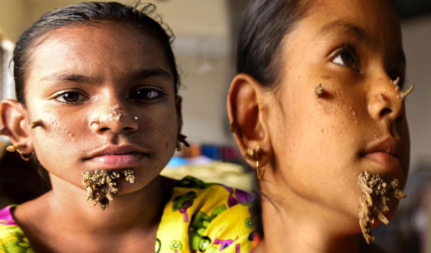 First Tree Woman Found In Bangladesh To Be Cure With The Dieases