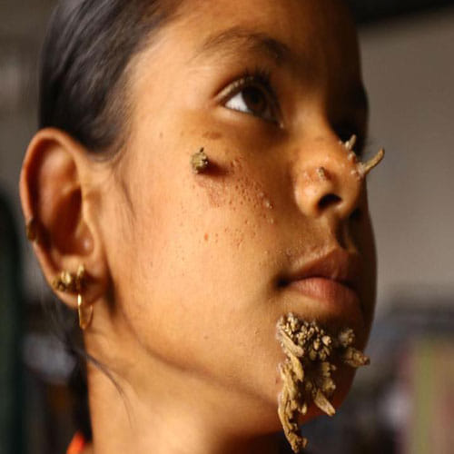 First Tree Woman Found In Bangladesh To Be Cure With The Dieases