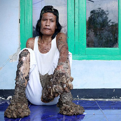 First Tree Woman Found In Bangladesh To Be Cure With The Dieases