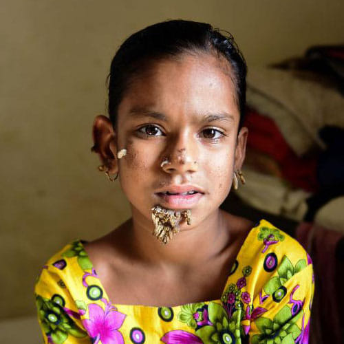 First Tree Woman Found In Bangladesh To Be Cure With The Dieases