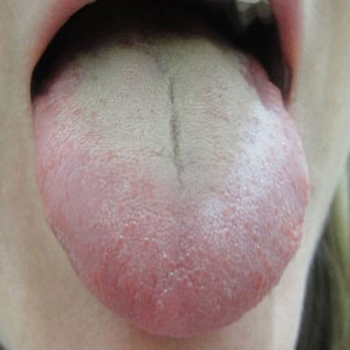 Tongue Color tells About Your Health
