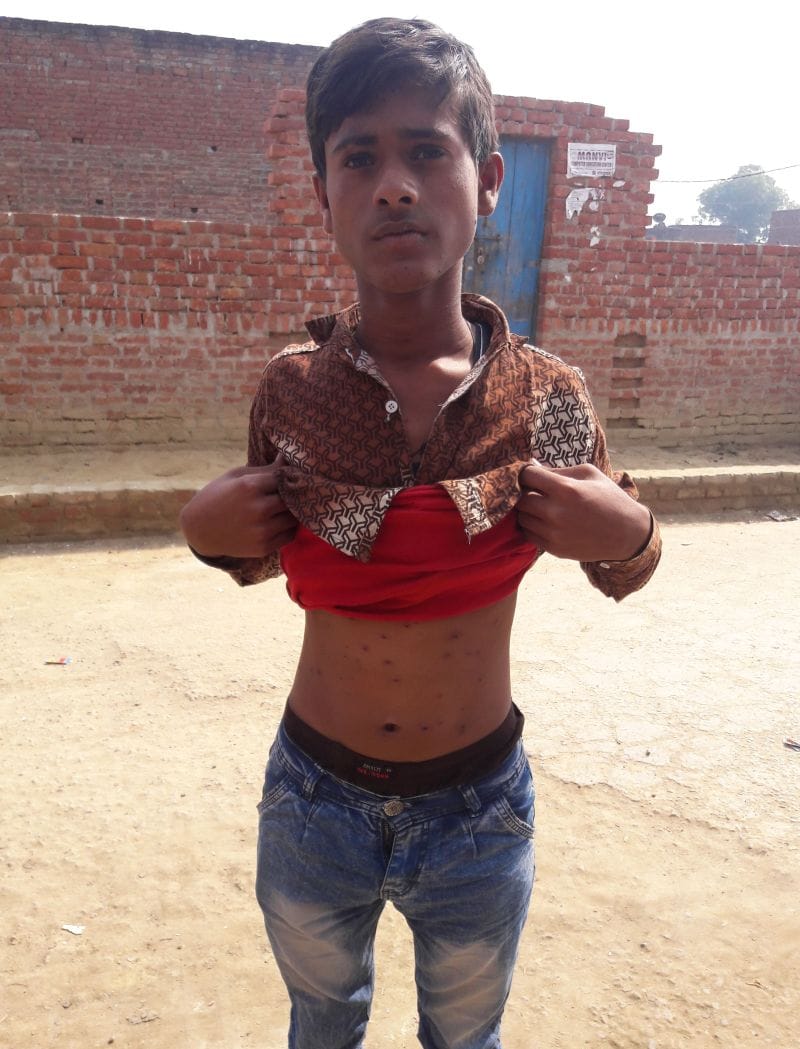 Sati Nagar outbreak of chicken pox, a dozen victims