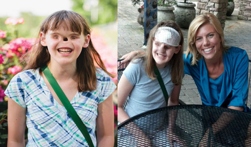 Cassidy Hooper-Girl Born Without Eyes And Nose Now Goes To College