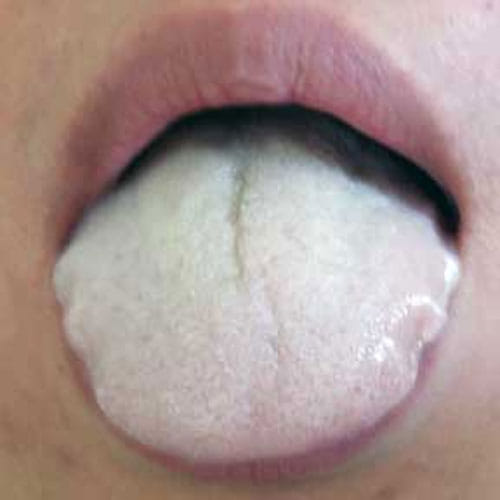 Tongue Color tells About Your Health
