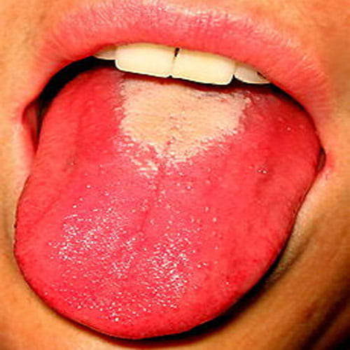 Tongue Color tells About Your Health