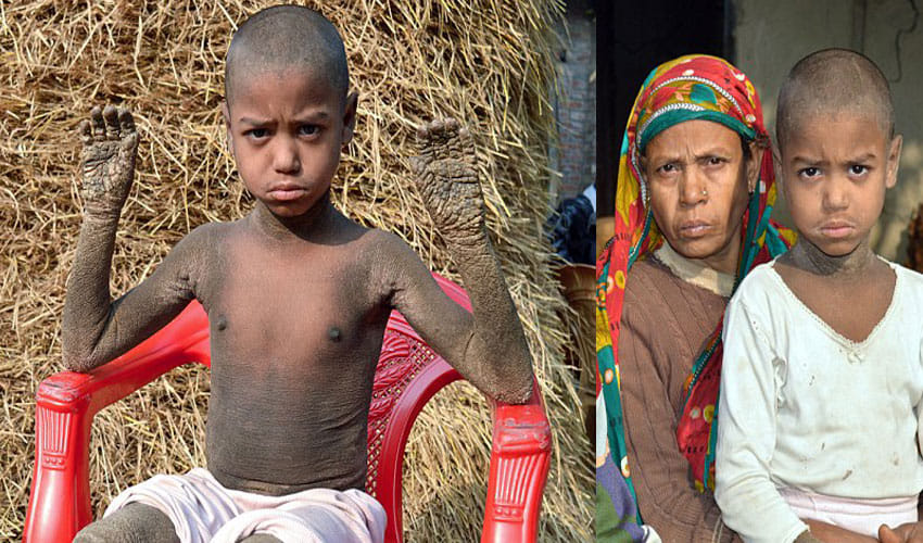 Kid In Bangladesh Is Slowly Turning Into Stone Due To An Incurable Diesease